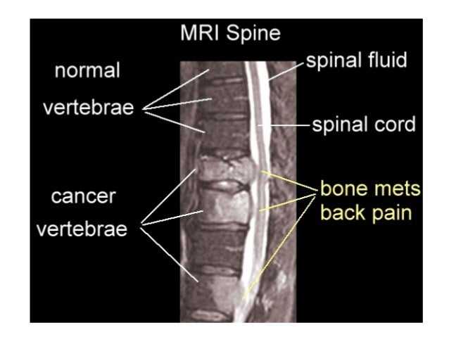 breast cancer in the spinal column Picture of eva longoria pussy